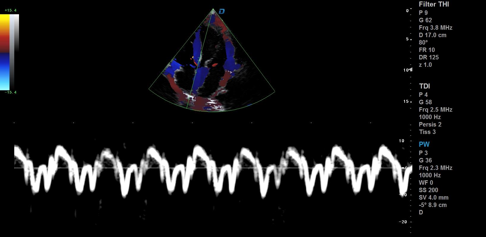 心臟彩超機和超聲心動圖的區別？